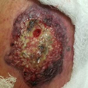 Pyoderma Gangrenosum