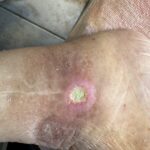 Comprendre les ulcères de jambe : causes et traitements