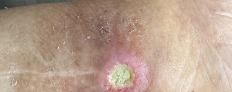 Comprendre les ulcères de jambe : causes et traitements Comprendre les ulcères de jambe : causes et traitements