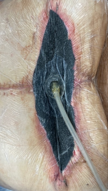 Mousse hydrophobe et poreuse en aspiration.