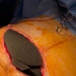 TPN Traitement des plaies par pression négative : avantages et applications