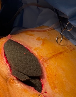 Mousse hydrophobe et poreuse avant aspiration,
sans souffrance péri-lésionnelle.