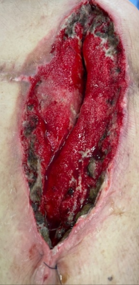 Plaie avec perte de substance bourgeonnante après retrait du TPN