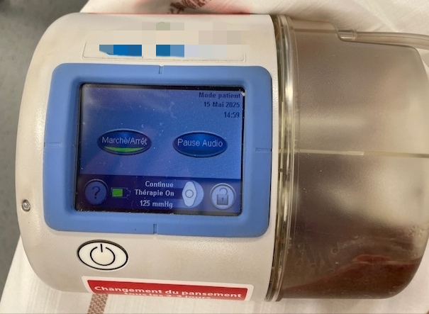 Pompe avec réservoir de TPN de type générateur mobile.