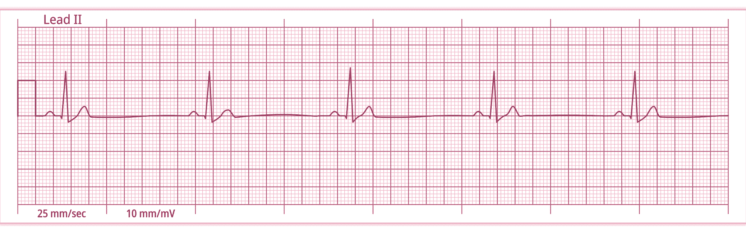L’activité électrique sans pouls (AESP)