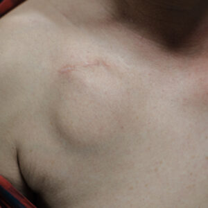 Défibrillateur implantable