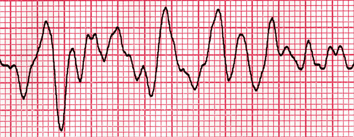 fibrillation ventriculaire (FV) fibrillation ventriculaire (FV)
