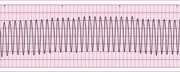 tachycardie ventriculaire sans pouls (TV)