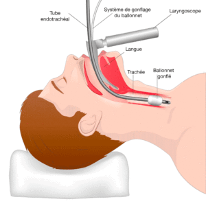 Intubation orotrachéale