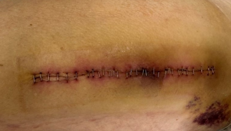 Suture par agrafe avec présence d'hématome Suture par agrafe avec présence d'hématome