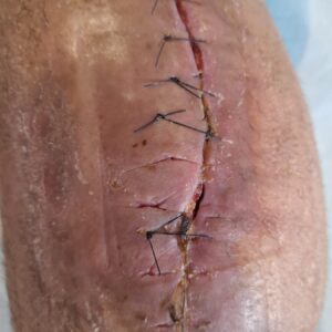 Suture à points séparés trop serrés avec désunion de cicatrice Suture à points séparés trop serrés avec désunion de cicatrice