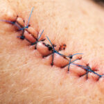 Sutures cutanées : techniques, indications et surveillance