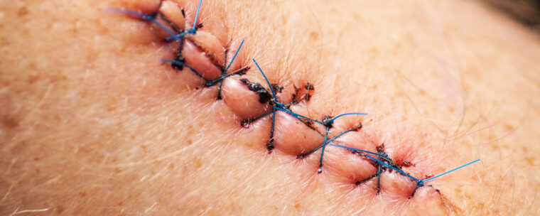 Sutures cutanées : techniques, indications et surveillance Sutures cutanées : techniques, indications et surveillance