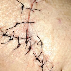 Suture à points séparés Suture à points séparés