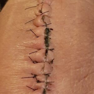 Suture à points séparés trop serrés et présence de croûtes Suture à points séparés trop serrés et présence de croûtes