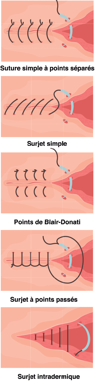 sutures sutures