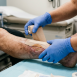 Ulcère de jambe veineux : simplifier la détersion tout en réduisant le temps de cicatrisation