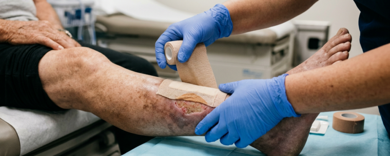 Ulcère de jambe veineux : simplifier la détersion tout en réduisant le temps de cicatrisation Ulcère de jambe veineux : simplifier la détersion tout en réduisant le temps de cicatrisation