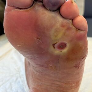 Ischémie du troisième orteil compliquant un mal perforant associé à une ostéoarthrite du quatrième orteil.