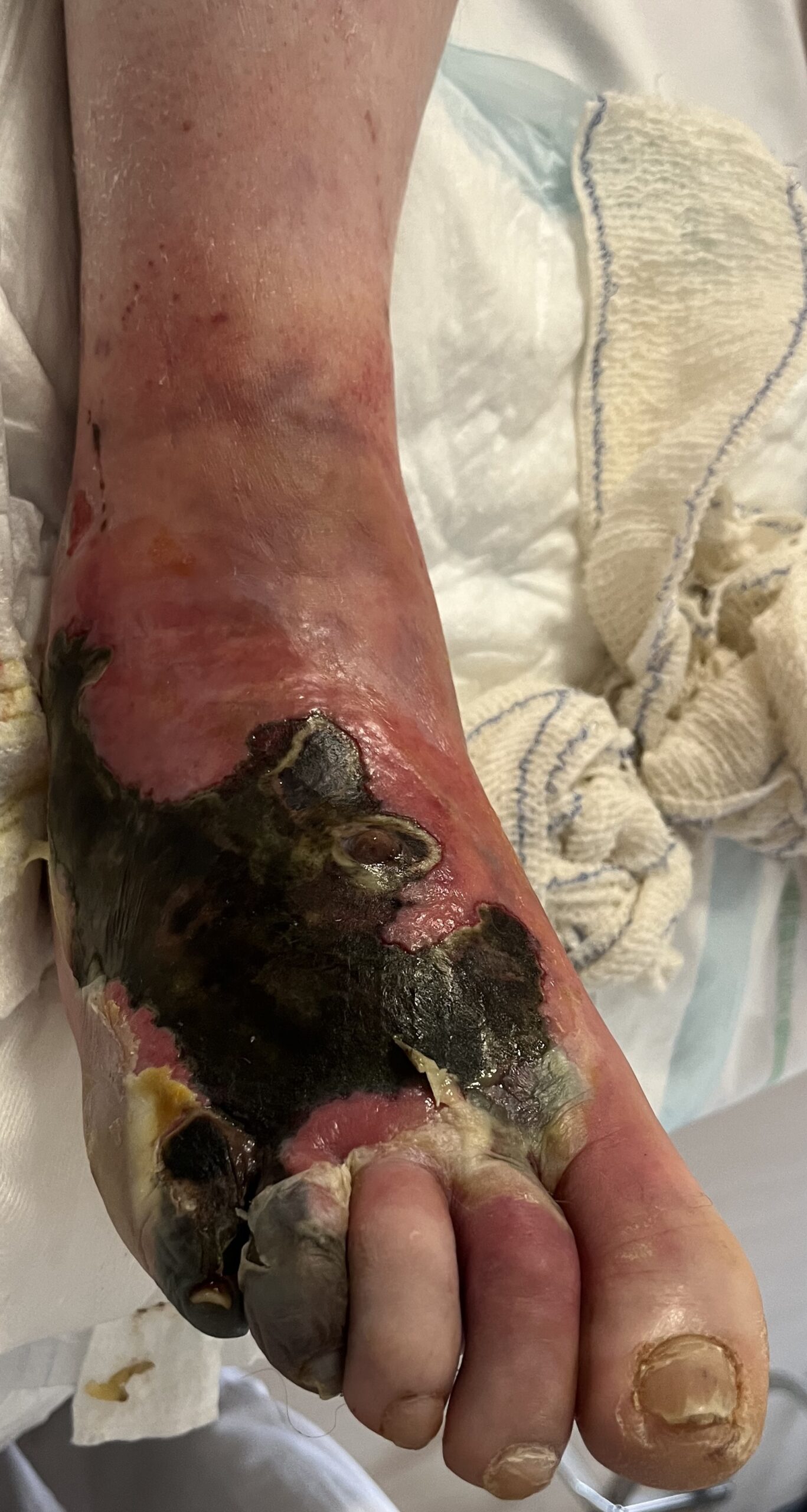 Nécrose surinfectée d’origine vasculaire. Nécrose surinfectée d’origine vasculaire.