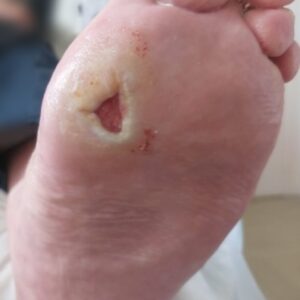 Mal perforant plantaire en regard de la métatarsophalangienne de l'hallux, avec risque d'ostéoarthrite.